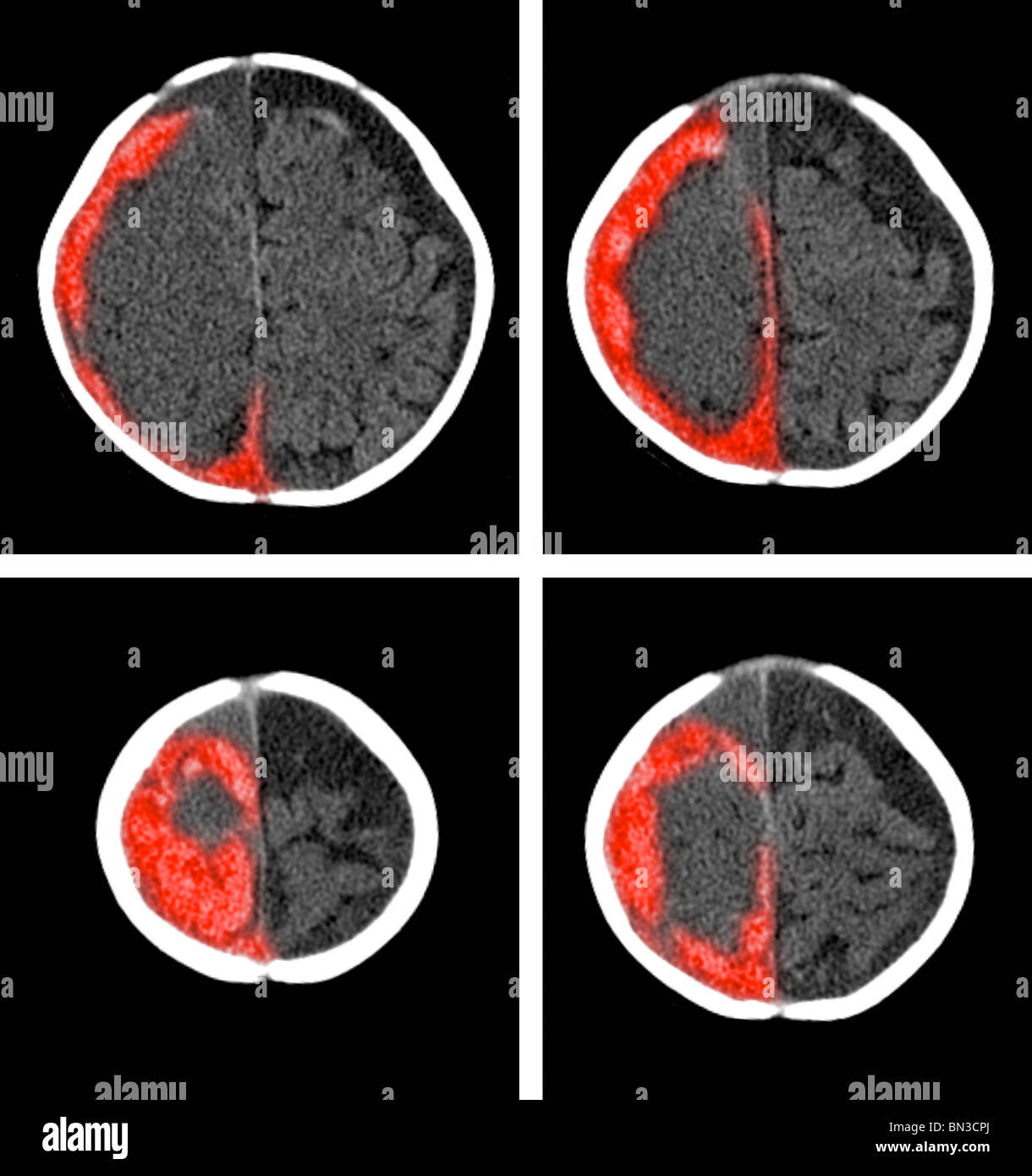 Colorizzato CT scan mostra un l'ematoma subdurale (rosso) in un periodo di 6 mesi per la old boy Foto Stock