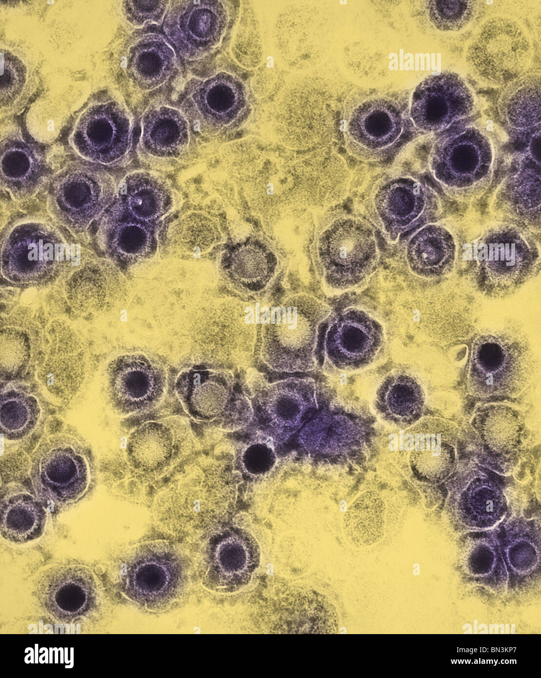 Negativamente macchiate di microscopio elettronico a trasmissione (TEM) di numerosi virus herpes simplex i virioni Foto Stock