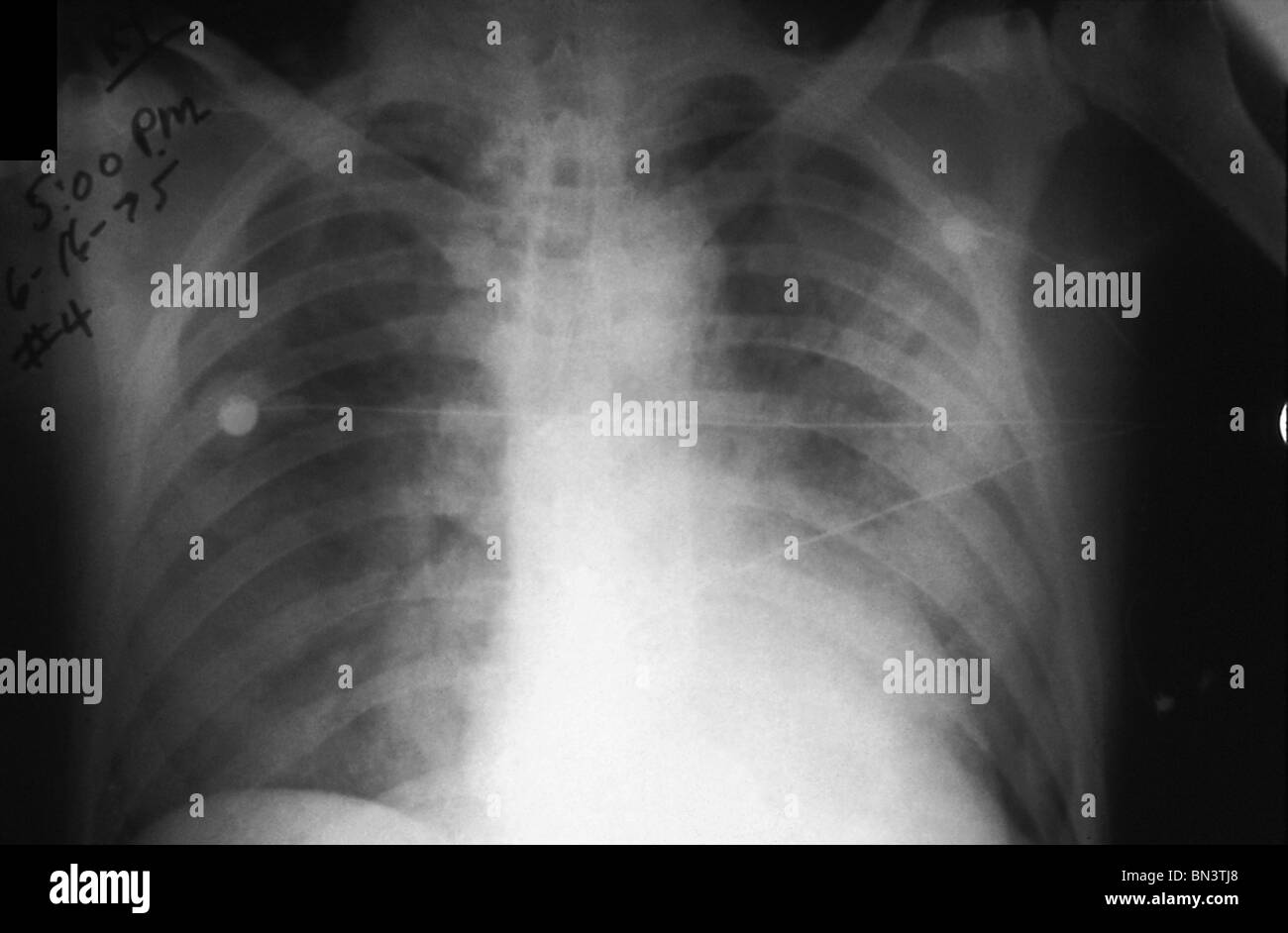 I raggi x al torace che mostra infezione da peste che coinvolgono entrambi i campi polmonari, i raggi x al torace di una persona con la peste Foto Stock