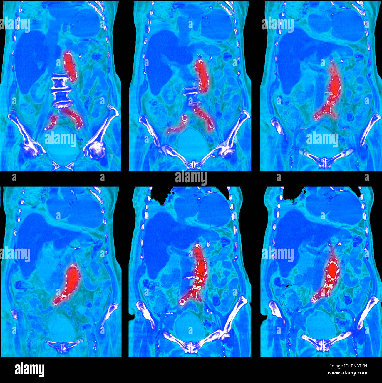 Scansione CT dell'addome che mostra un aneurisma aortico e estesa aterosclerosi arteriosa Foto Stock