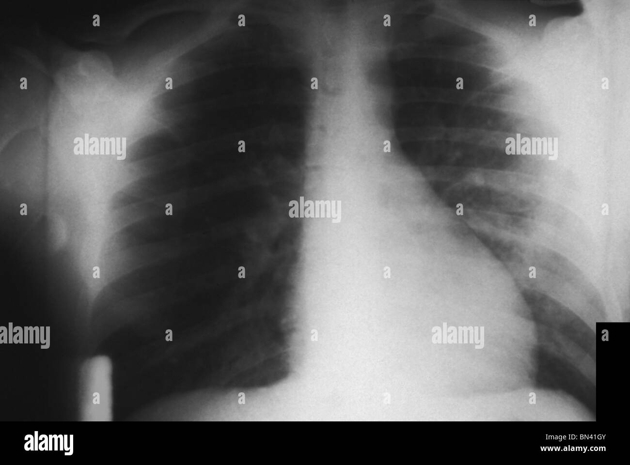 I raggi x al torace che mostra bilaterali infezione polmonare in un paziente con la peste Foto Stock