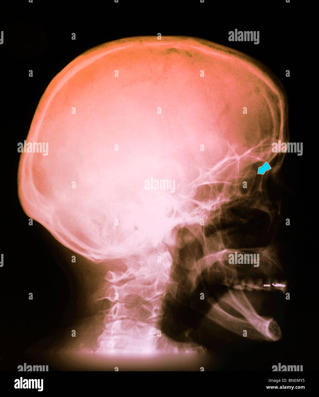 Cranio x-ray di una donna shot nell'occhio con una pistola di pellet. Foto Stock