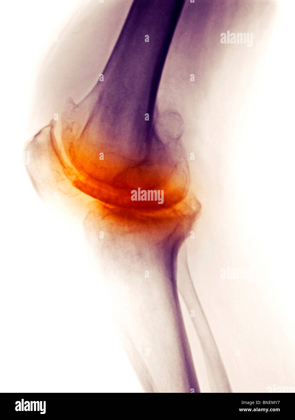 X-ray mostra osteoartrite del ginocchio Foto Stock