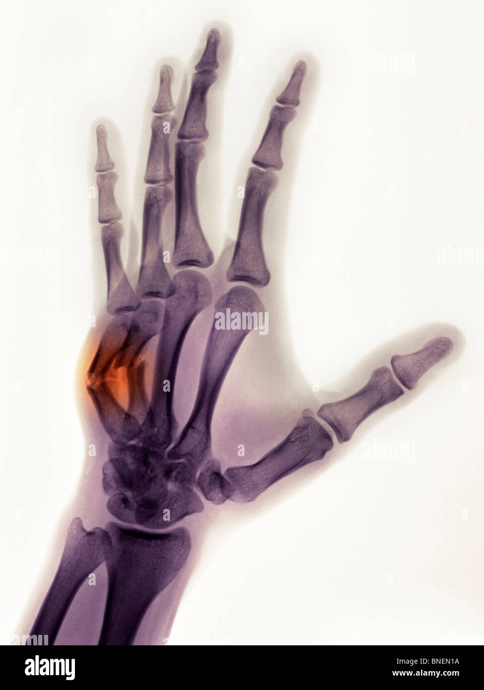 Mano x-ray mostra un boxer di guarigione di fratture Foto Stock