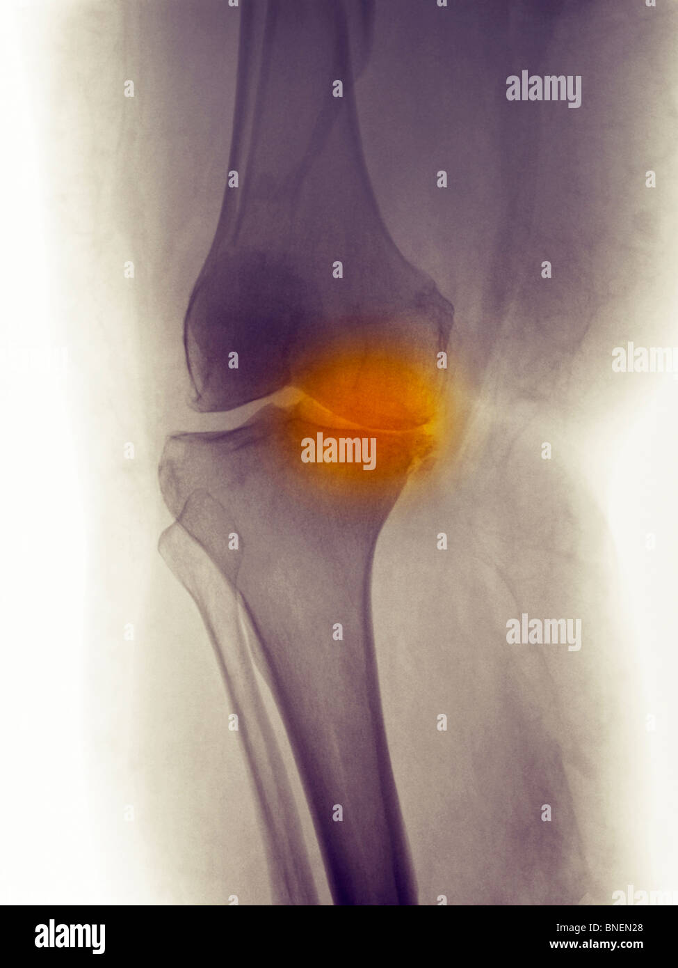 Ginocchio raggi x di 60 anno vecchia donna mostra comune malattia degenerativa da osteoartrite Foto Stock