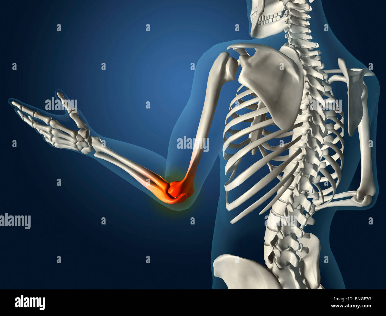 Vista a raggi X del giunto a gomito di colore rosso con infiammazione in un vedere-attraverso il braccio con la mano e le ossa della colonna vertebrale Foto Stock