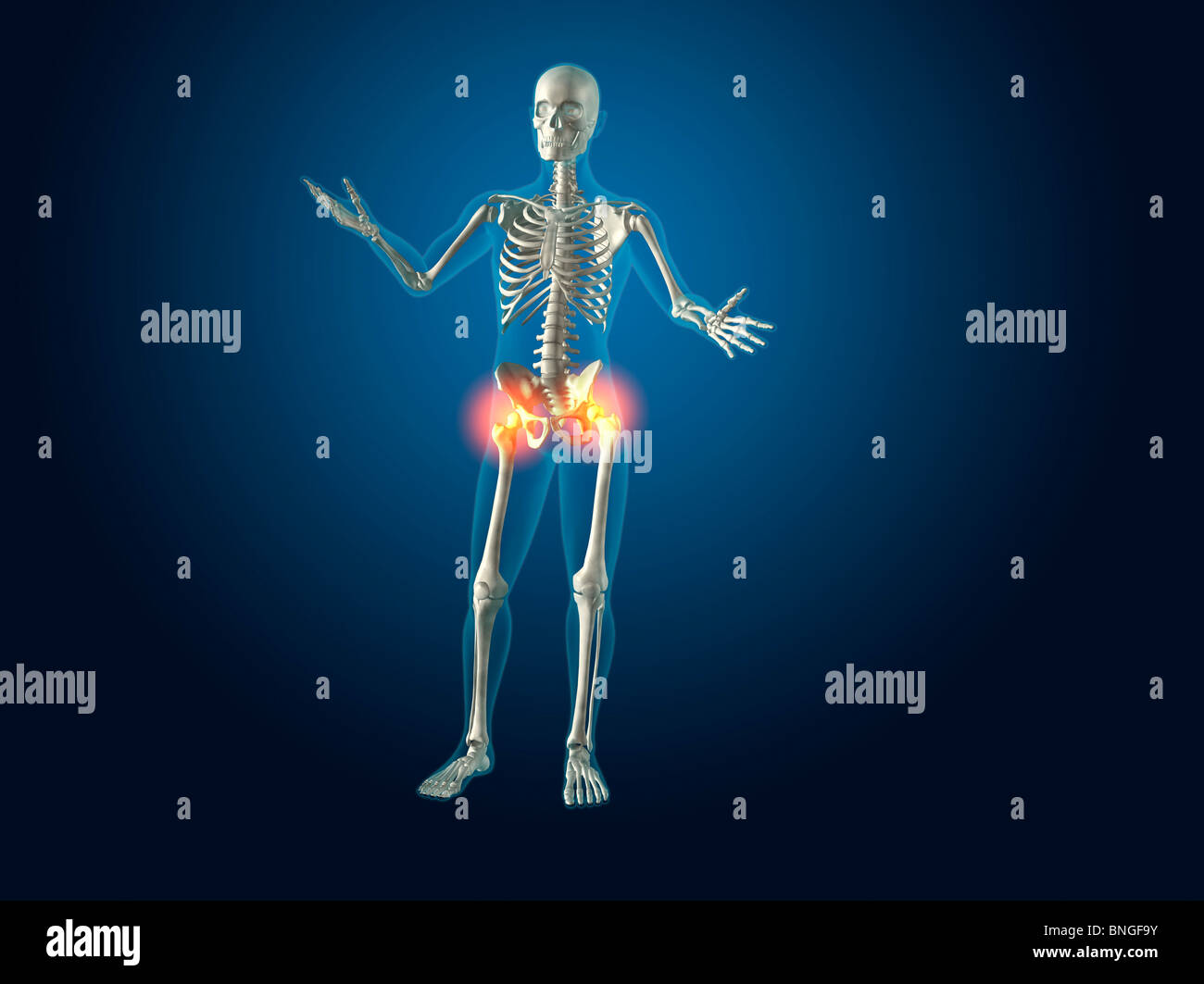 Vista ai raggi X di uno scheletro umano con hip infiammazione delle articolazioni Foto Stock