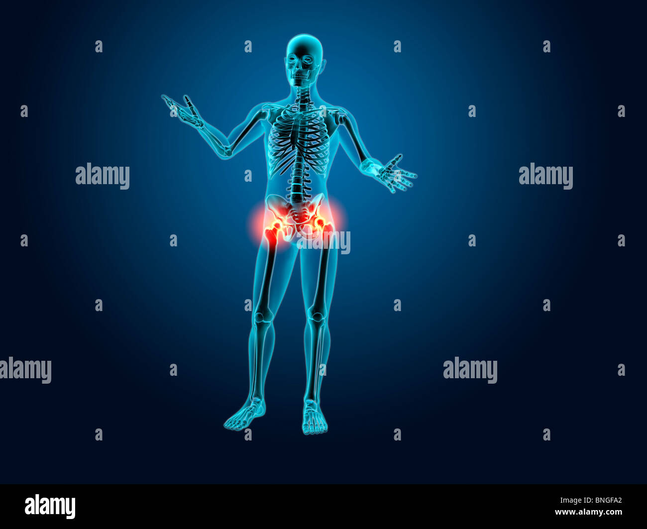 Vista ai raggi X di uno scheletro umano con hip infiammazione delle articolazioni Foto Stock