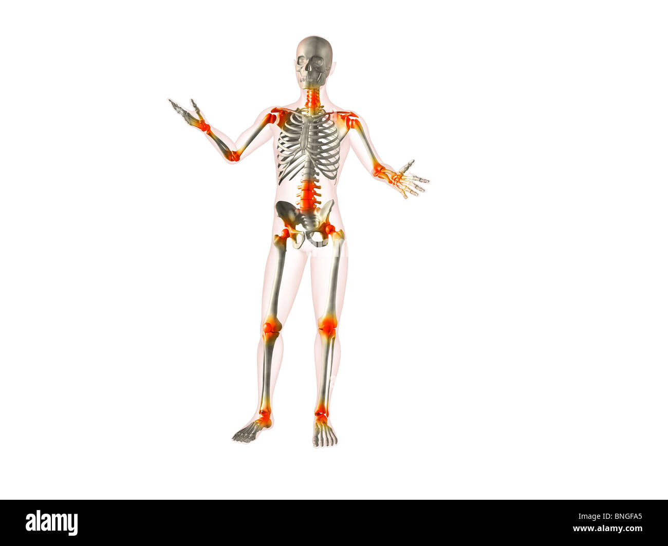 Vista ai raggi X di uno scheletro umano con infiammazioni articolari Foto Stock