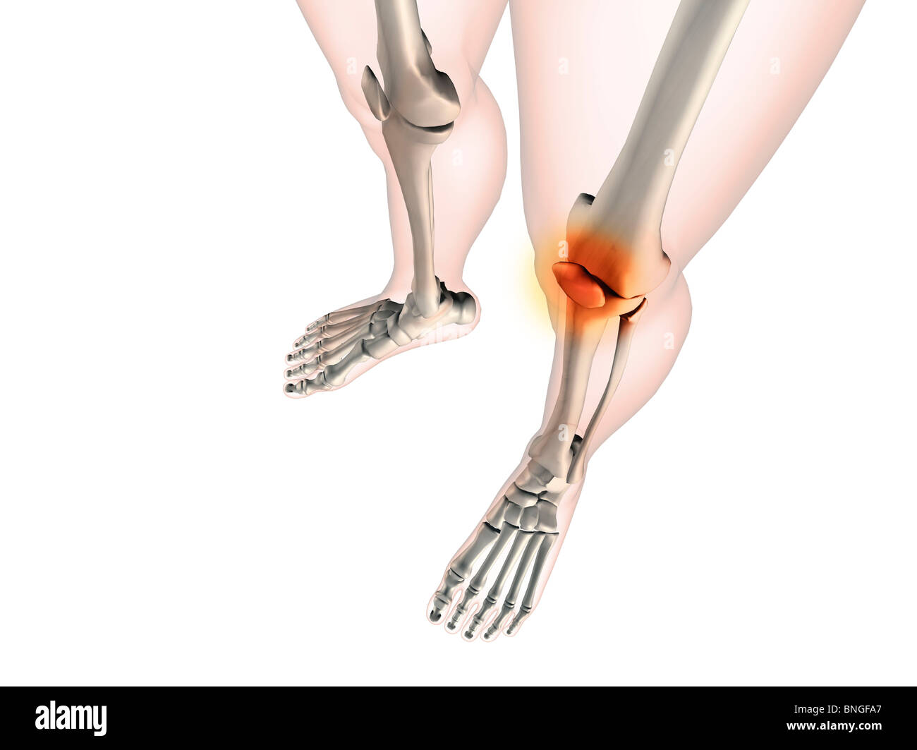 Vista ai raggi X di ginocchia con infiammazioni articolari Foto Stock