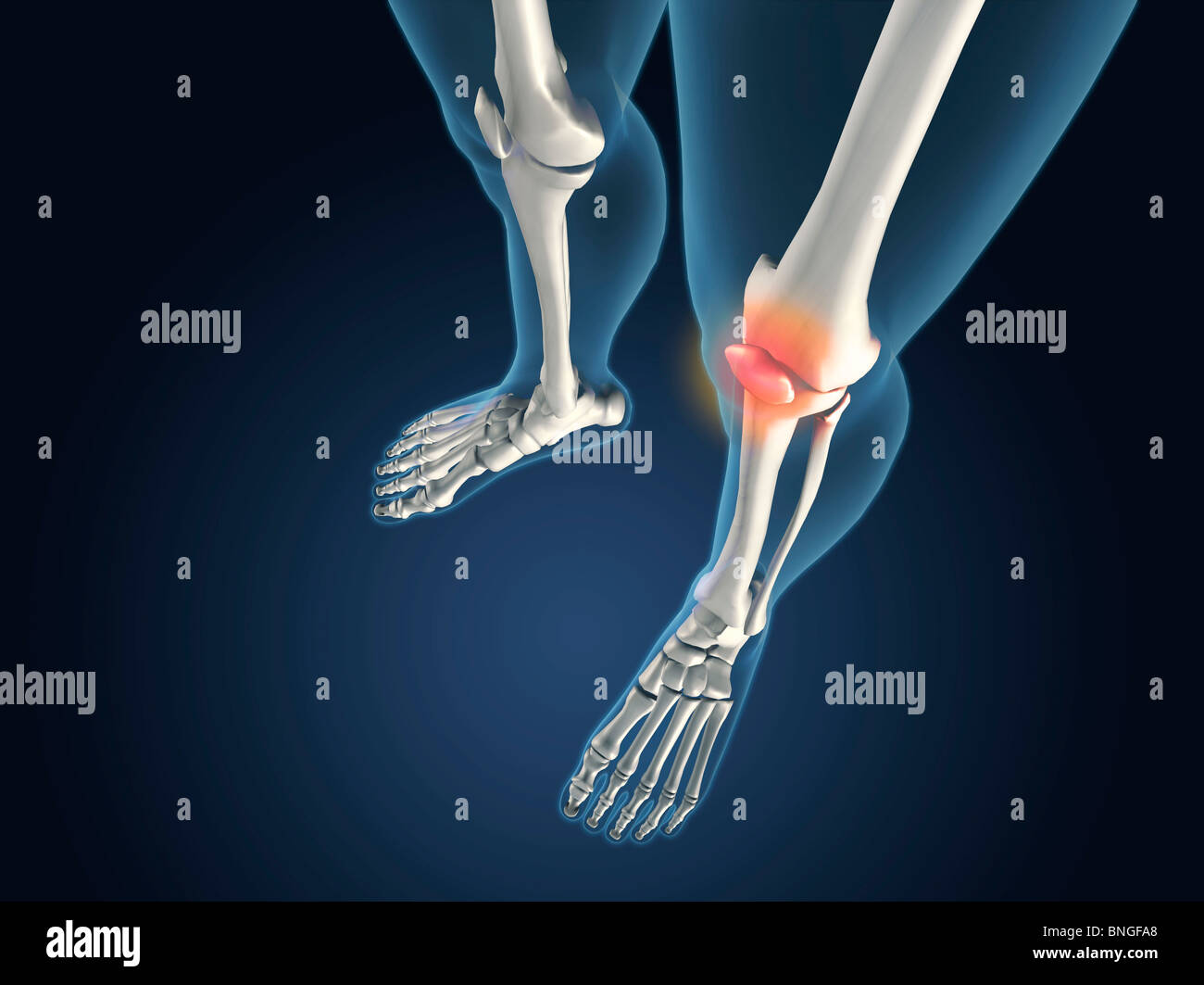 Vista ai raggi X di ginocchia con infiammazioni articolari Foto Stock