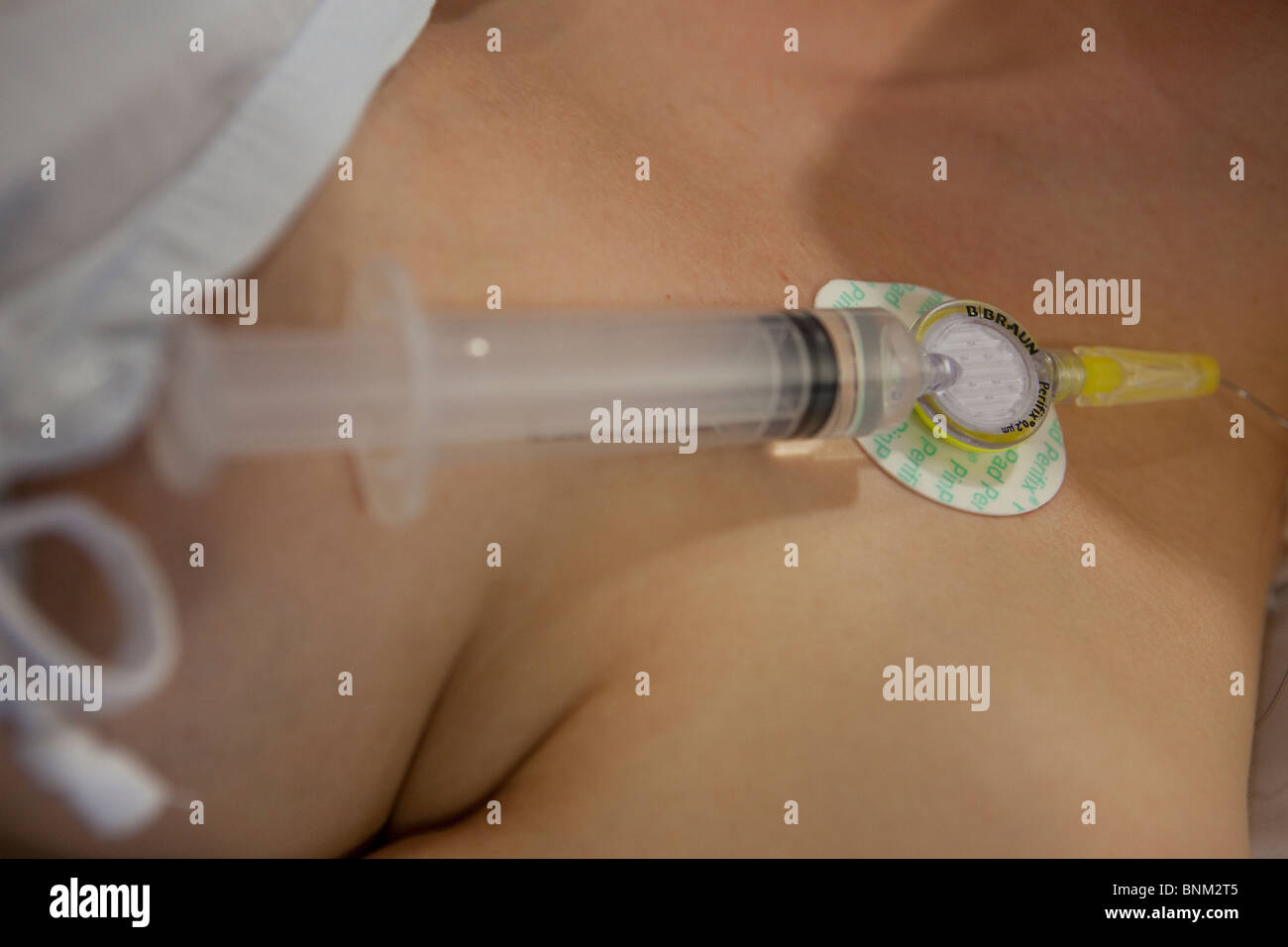 Close up di un edpidural siringa attaccata ad una donna in stato di gravidanza durante il lavoro Foto Stock