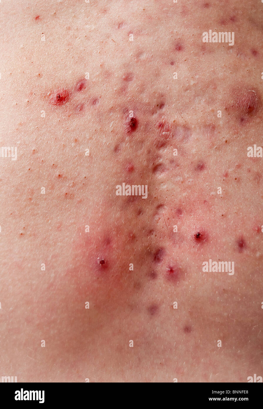 Closeup texture di un cattivo acne rash su un maschio bianco al torace. Foto Stock