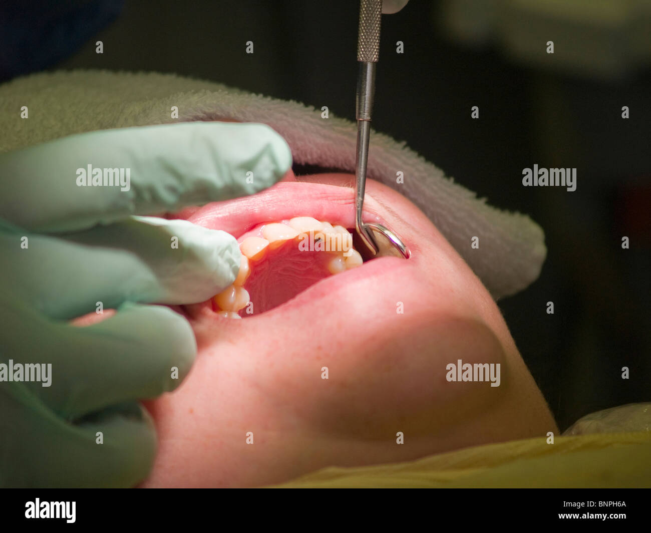Un dentista ispeziona la bocca aperta del suo paziente per cavità nei suoi denti. Primo piano dei suoi denti superiori e un riempimento Foto Stock