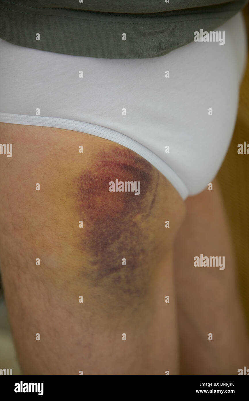 Una gamba contusa Foto Stock