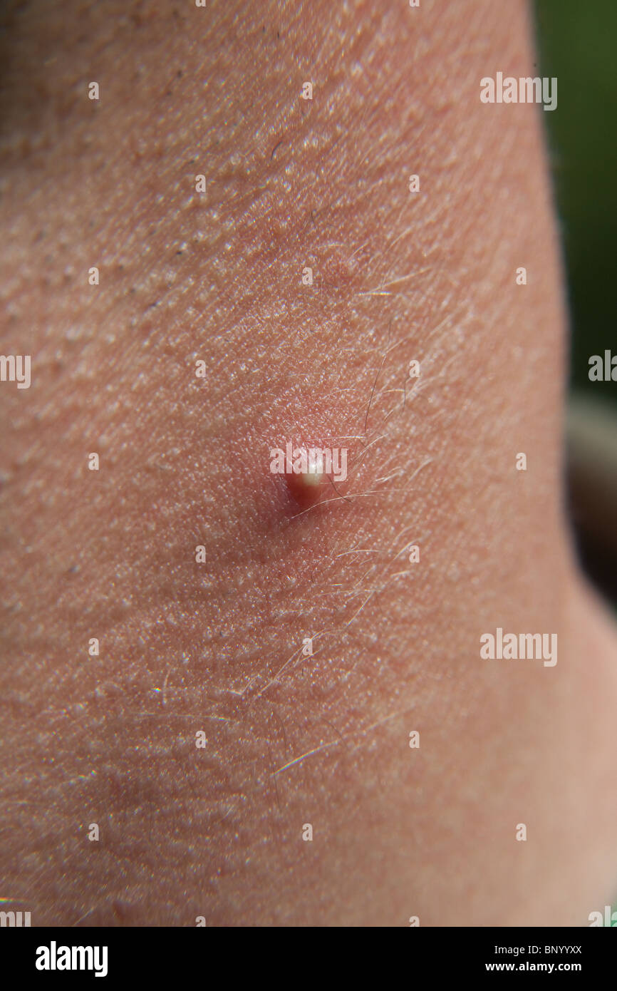 Grande spot acne o brufolo su un collo mans. Foto Stock