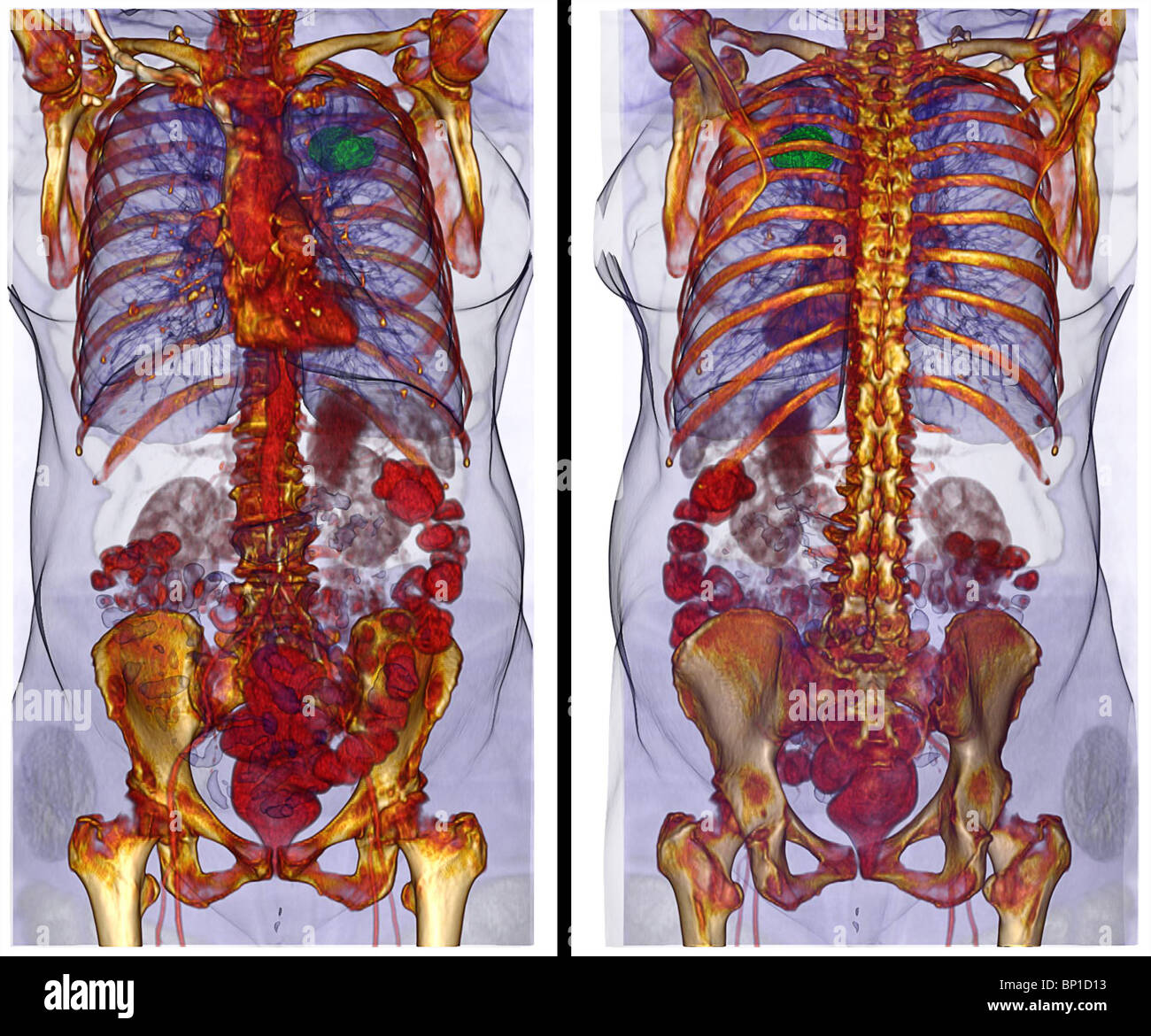 Scansione TC sezione assiale illustrante un cancro al polmone destro di 77 anni donna Foto Stock