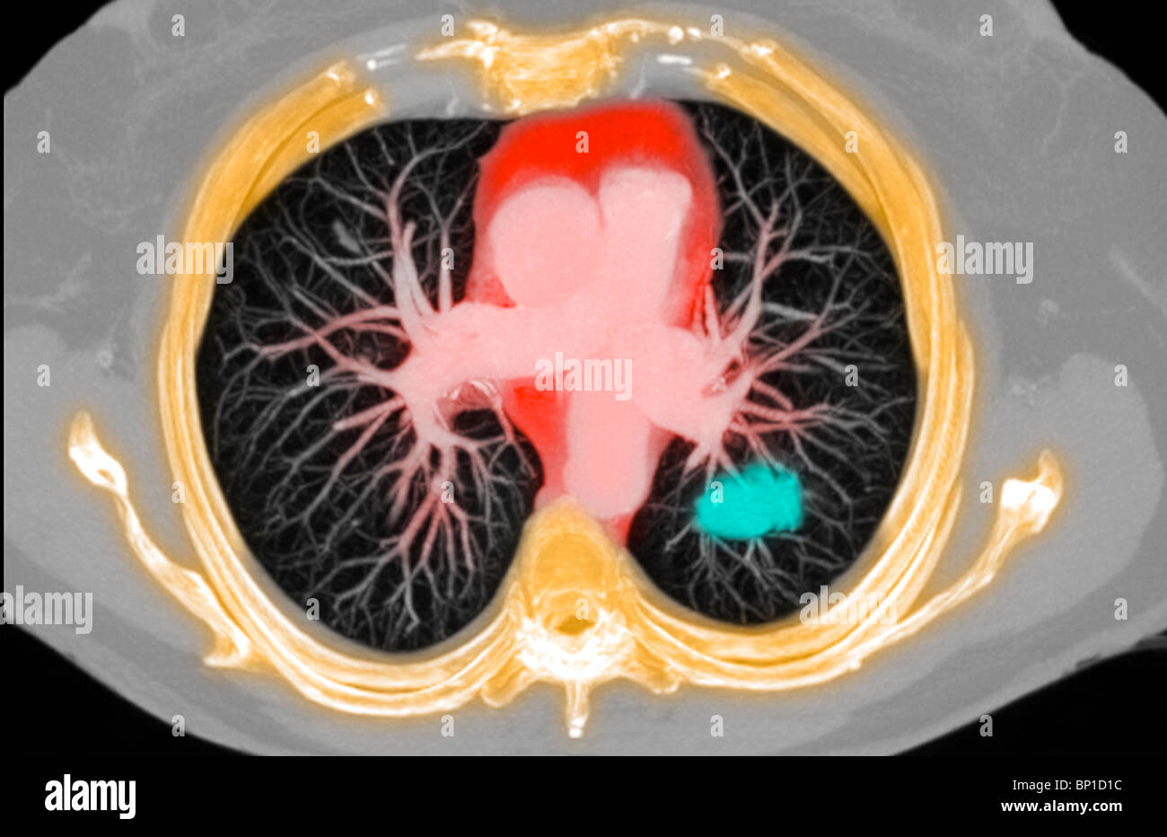 Scansione TC sezione assiale illustrante un cancro ai polmoni in 77 anni donna Foto Stock