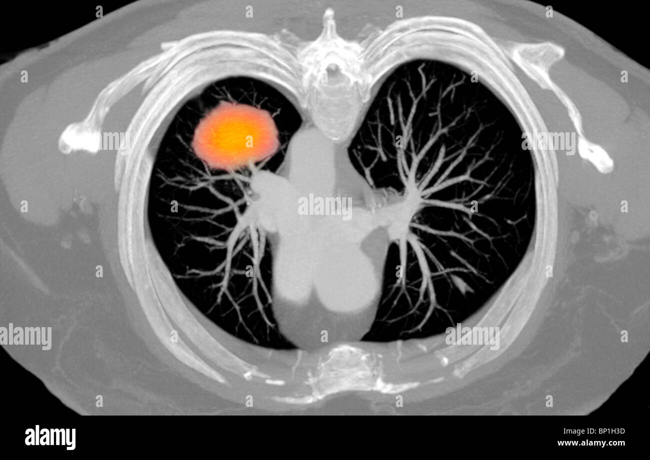 Scansione TC sezione assiale illustrante un cancro al polmone destro di 77 anni donna Foto Stock