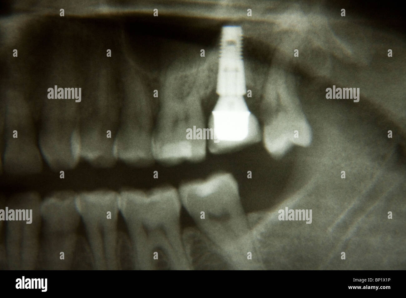 X-ray di impianto dentale Foto Stock
