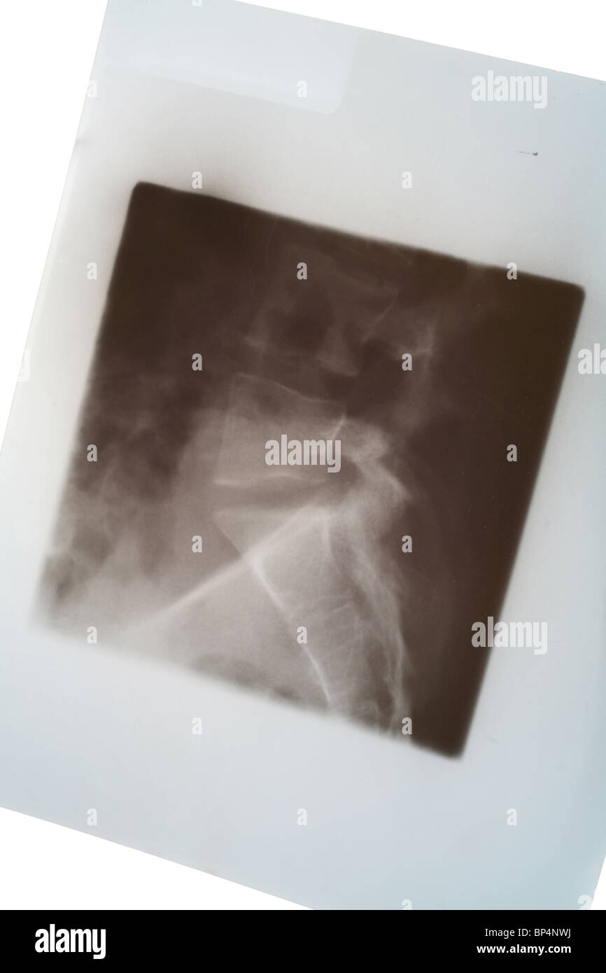 Un X-ray del ferito alla colonna vertebrale umana Foto Stock