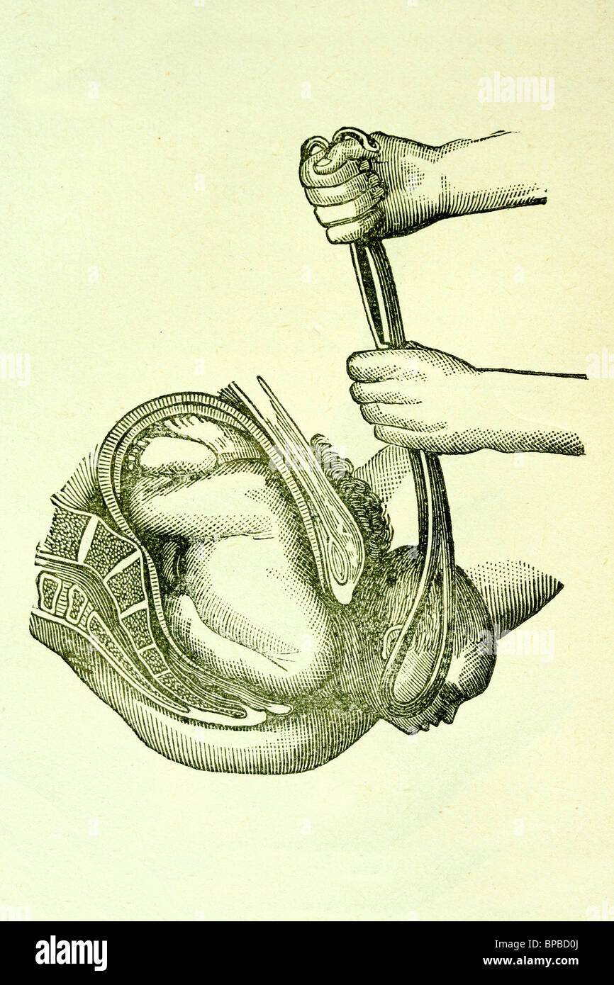 Forcipi in azione. Illustrazione di antiquariato. 1889. Foto Stock