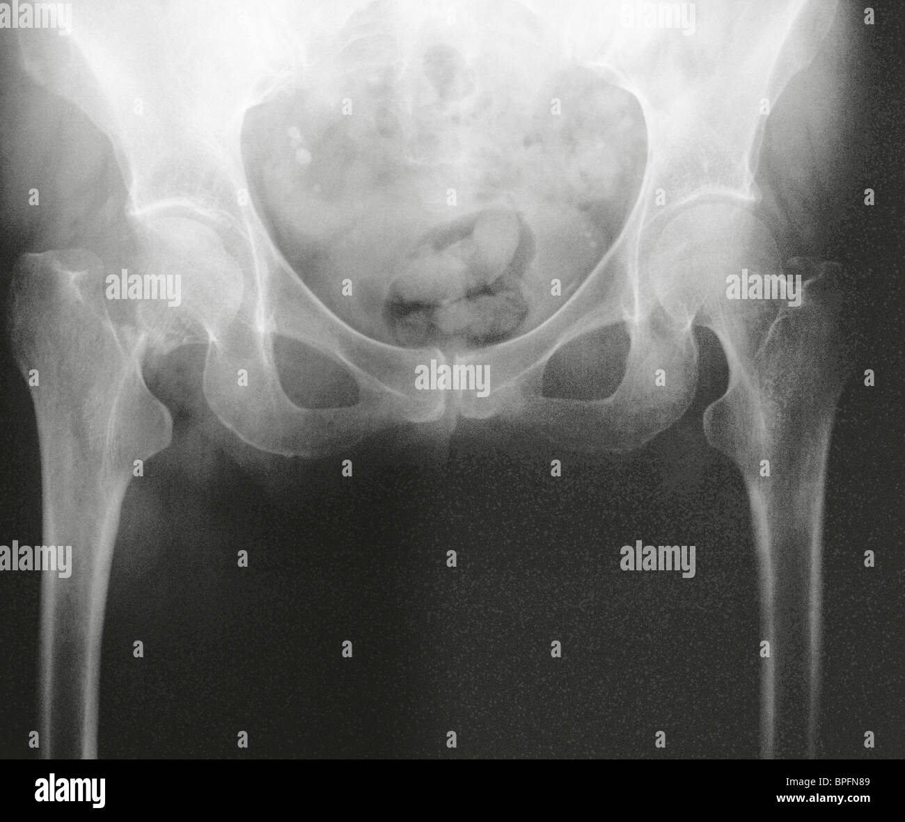 Questo paziente ha una frattura del collo del femore loro. Questa è una delle forme più comuni di frattura dell'anca. Foto Stock