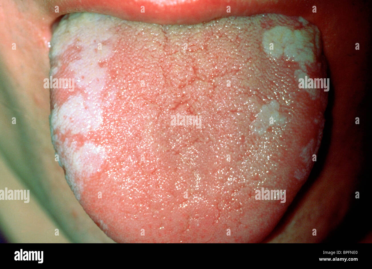 Iperplasia epiteliale della mucosa orale associata con il virus di Epstein-Barr Foto Stock