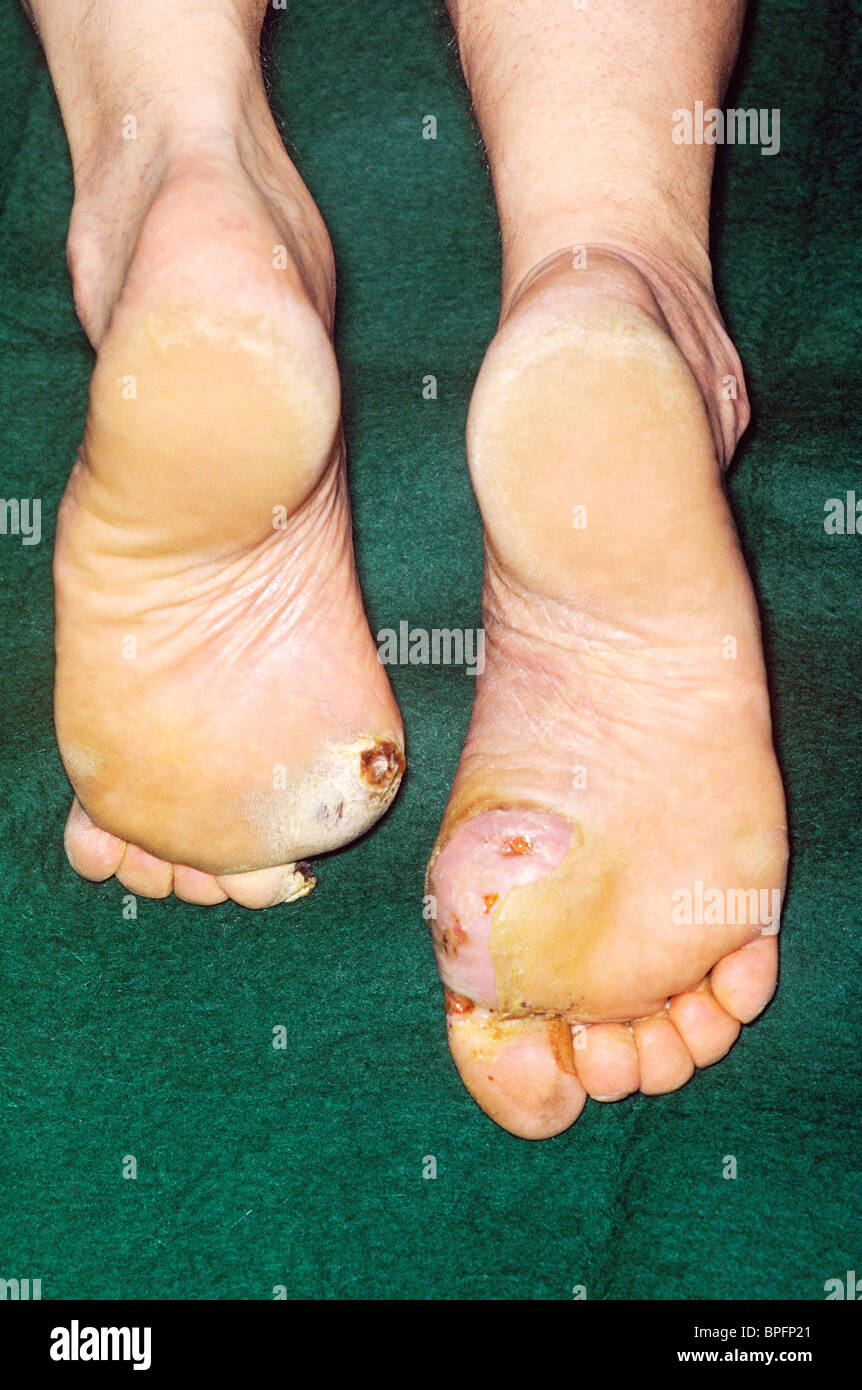 I piedi di un paziente diabetico che mostra la neuropatia Foto Stock