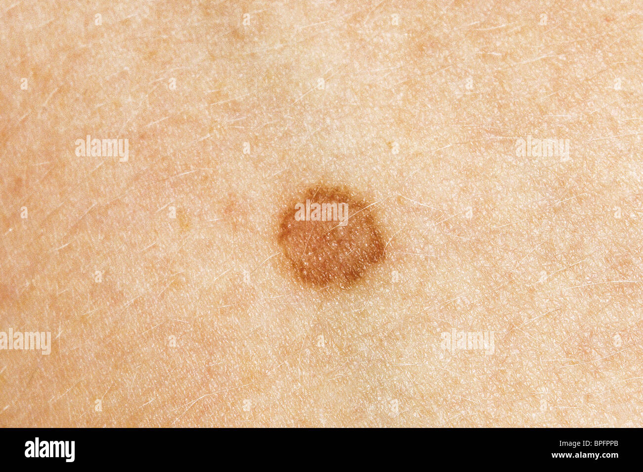 Un naevus, chiamato anche birthmark o mole è una pelle di colore spot che di solito è innocuo ma può diventare cancerosa. Foto Stock