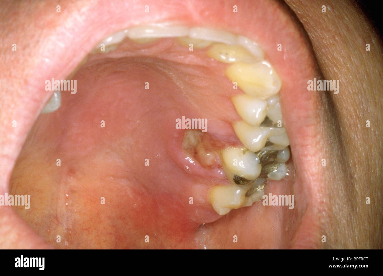 Ulcera della bocca Foto Stock