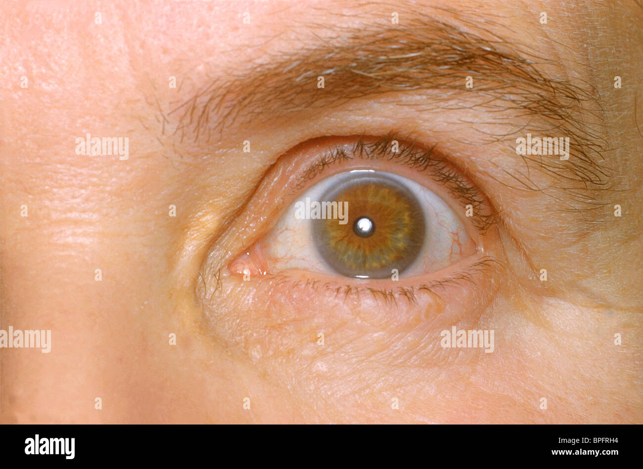 L'occhio sinistro di un paziente che mostra gli effetti di livelli anormalmente elevati di colesterolo nel sangue. Foto Stock