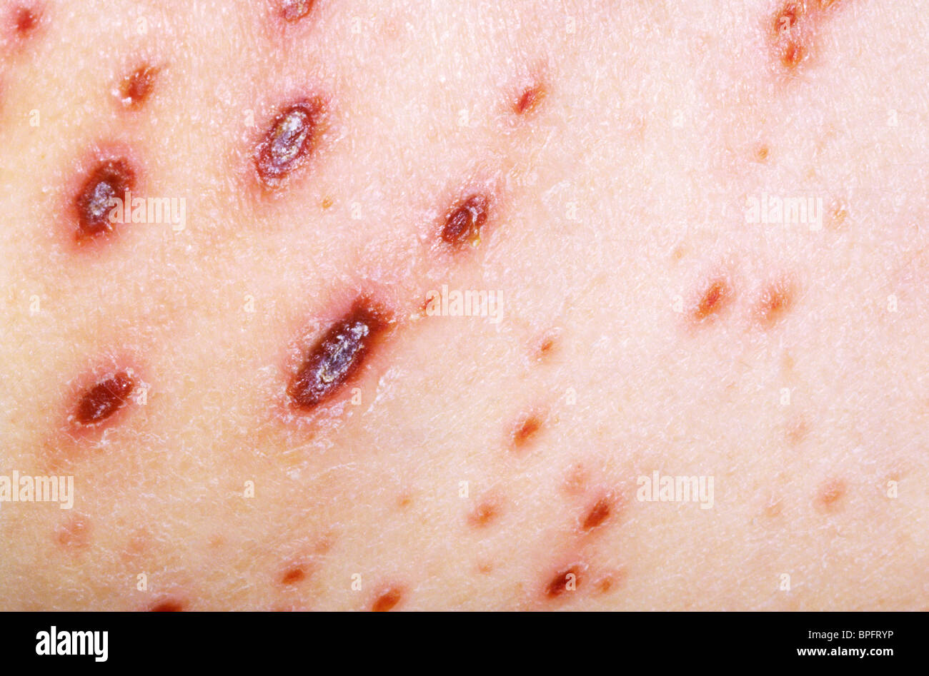 Una foto di una malattia altamente infettiva causata da varicella, un herpesvirus. Foto Stock