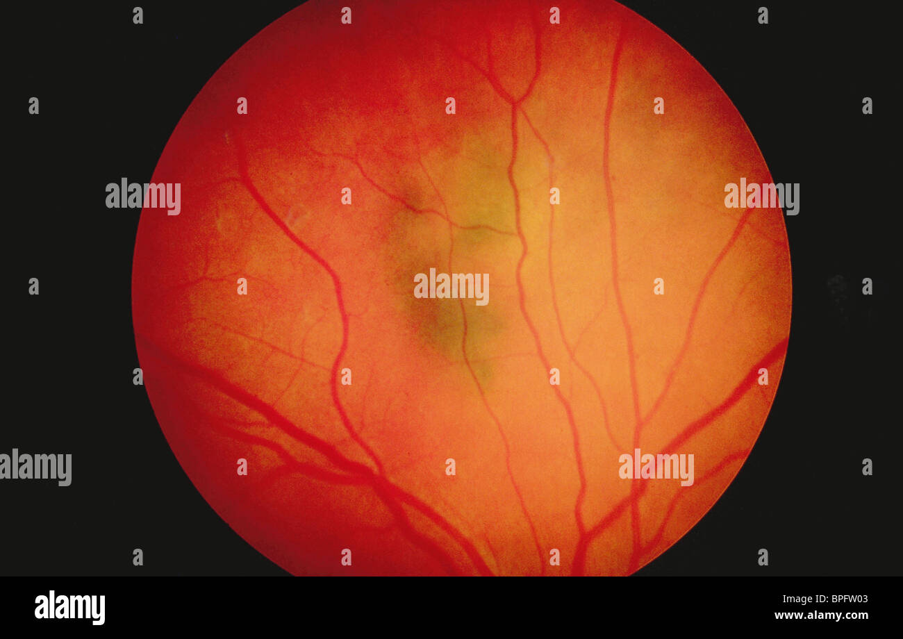 Un naevus retinica Foto Stock