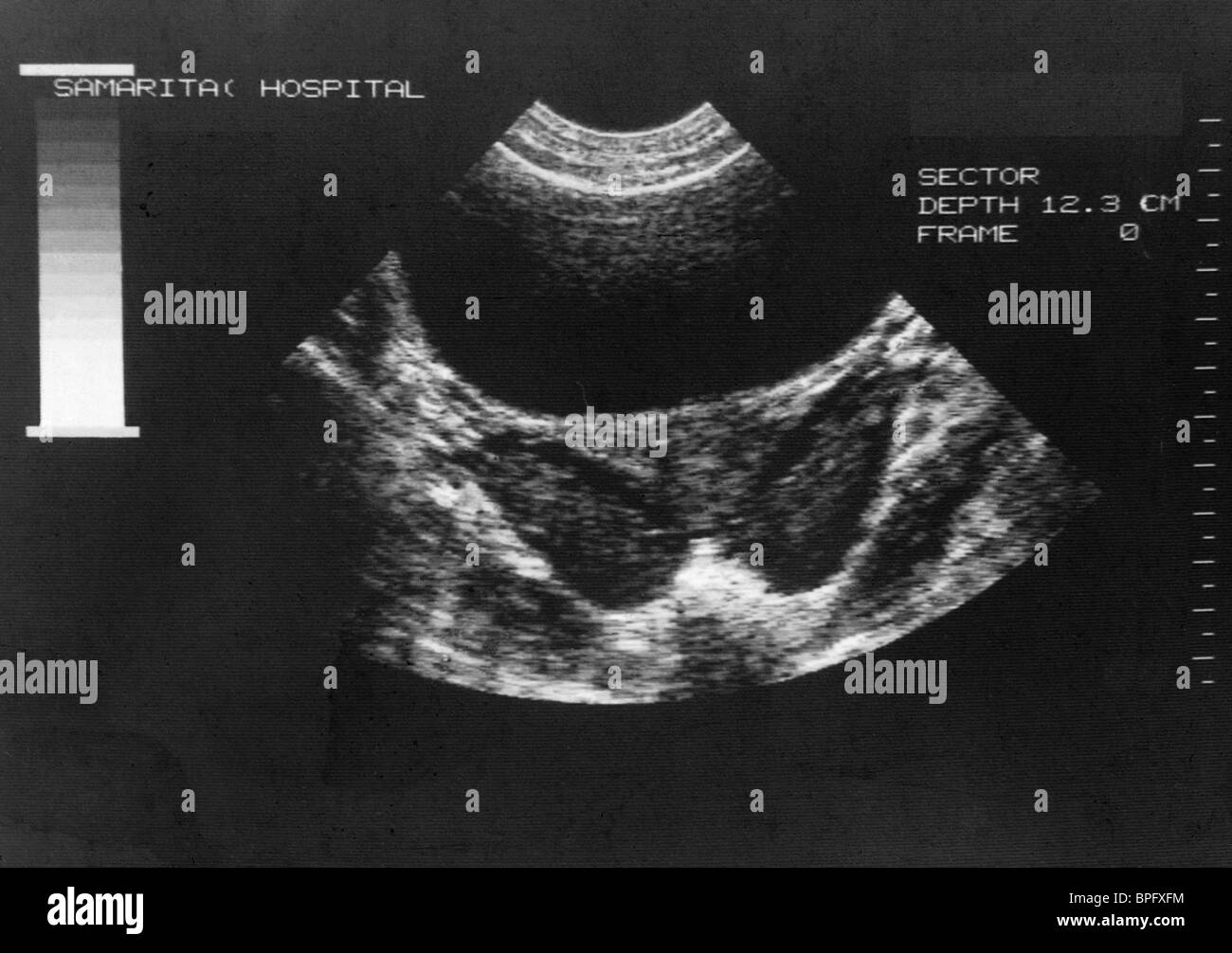 Scansione ad ultrasuoni che mostra ovarica policistica Foto Stock