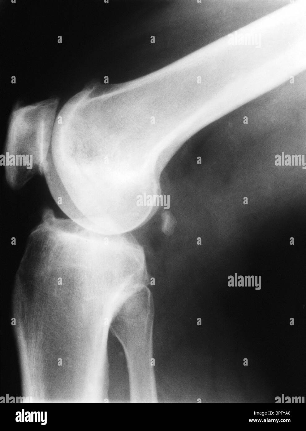X-ray di osteoartrite del ginocchio Foto Stock