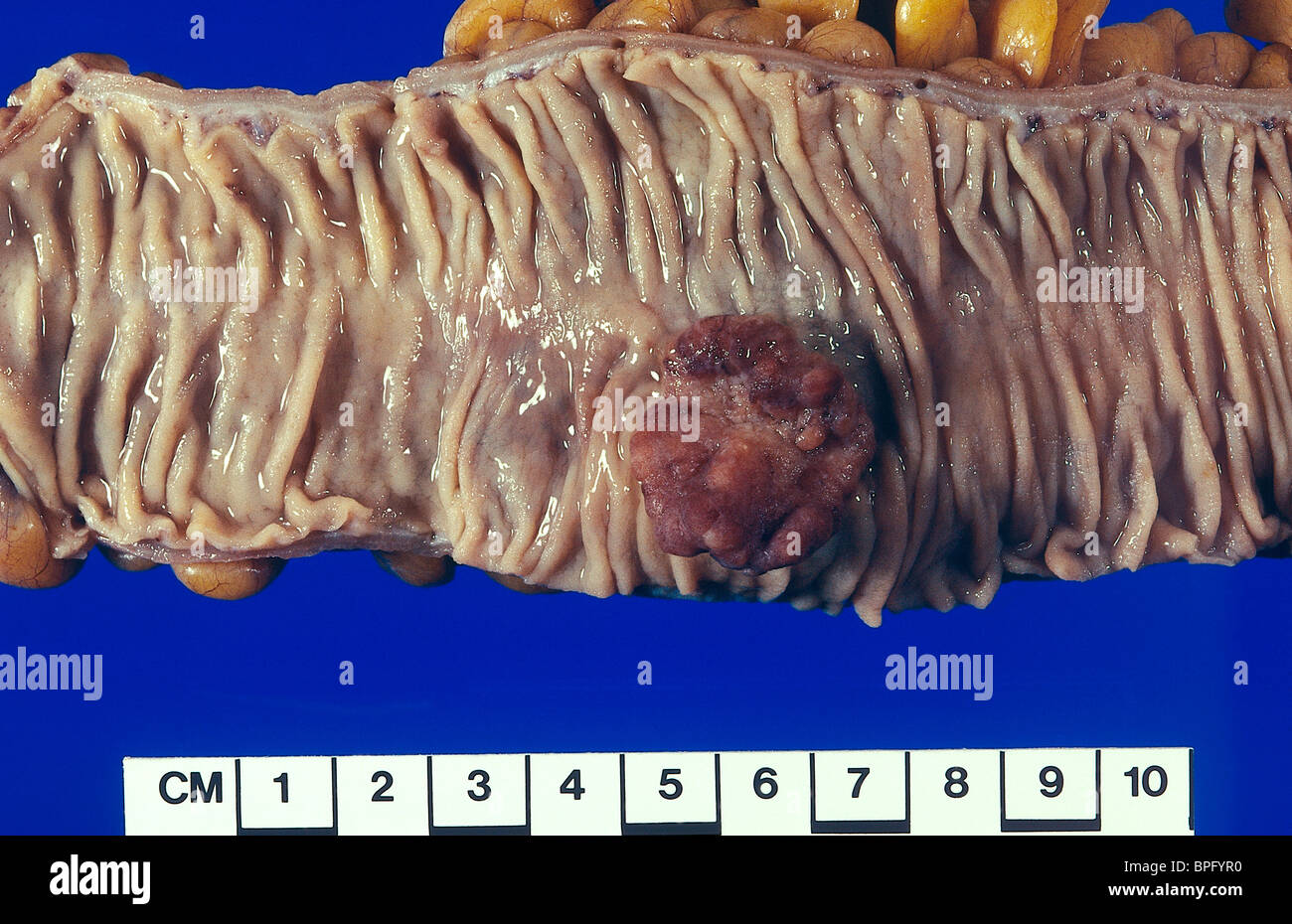 Cancro colorettale, chiamato anche il cancro al colon o grosso intestino cancro, include le crescite cancerose nel colon, retto e appendice. Foto Stock