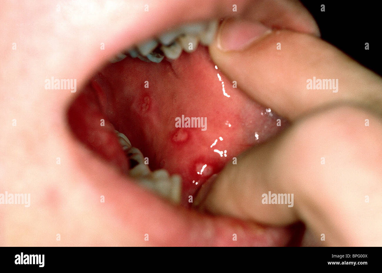 Una bocca ulcera, ulcera orale o, in inglese americano, batteriosi vascolare mal è una piaga aperta all'interno della bocca Foto Stock