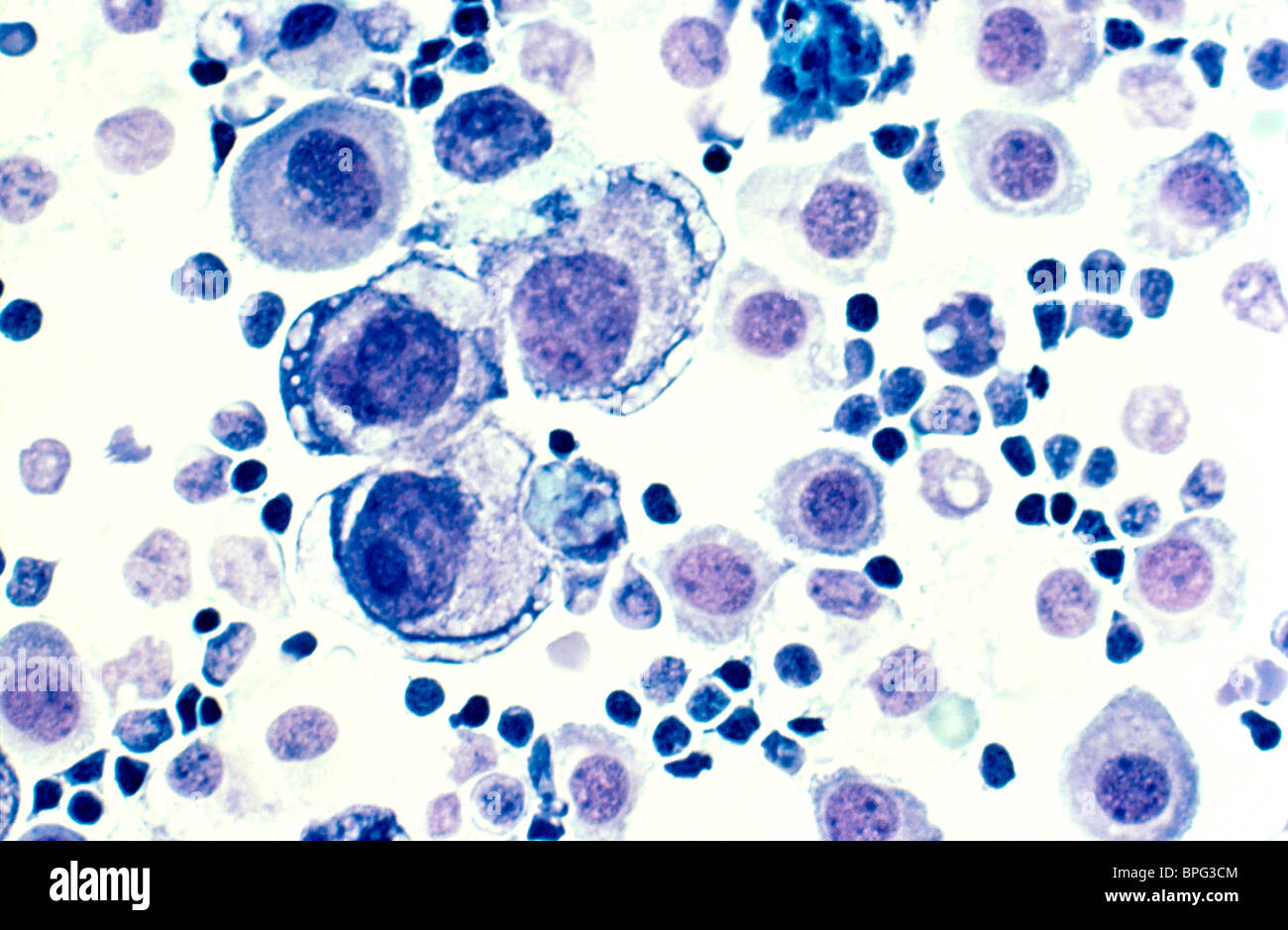 Human metastasi del cancro al seno nel fluido pleurico. Colorate con H&E e ingrandita a 400x. Foto Stock