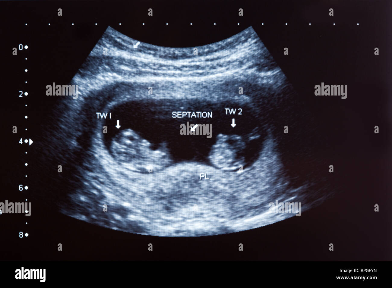 Scansione ad ultrasuoni di dieci mesi twin boys Foto Stock