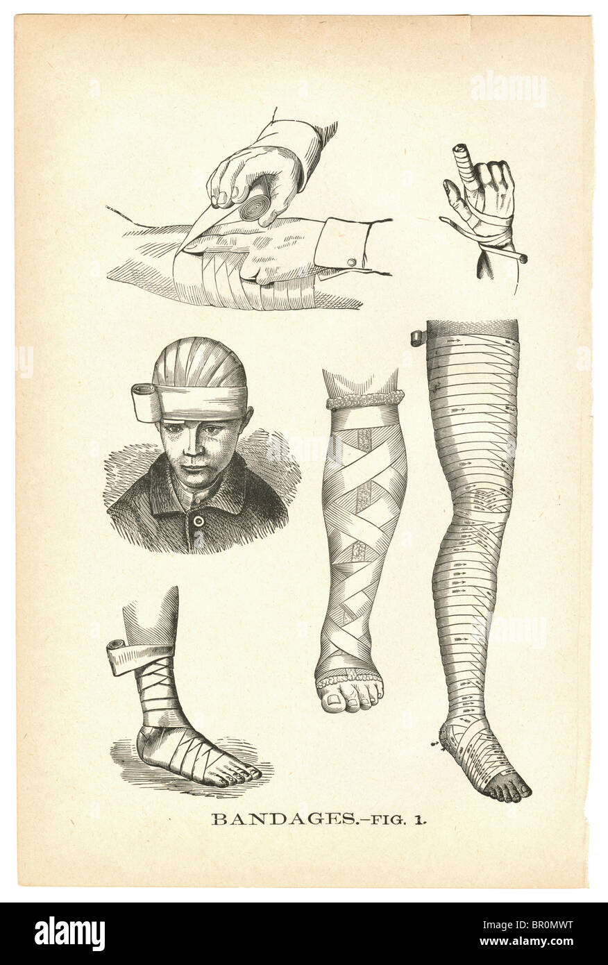 Le illustrazioni delle lesioni fasciata da un'annata medical prenota Foto Stock