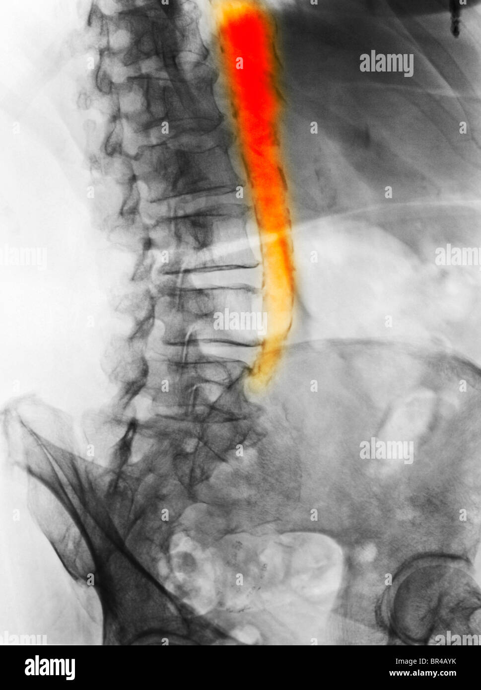 Addome x-ray di 80 anni di sesso femminile che mostra una aorta calcificato dalla arteria aterosclerotica malattia Foto Stock