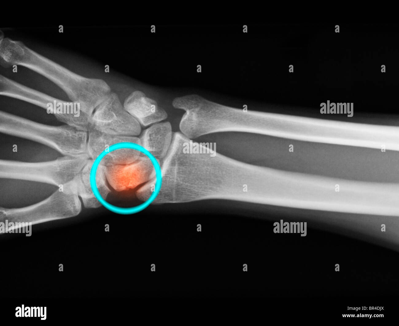Mano x-ray mostra una frattura della navicular o osso scafoide del polso Foto Stock