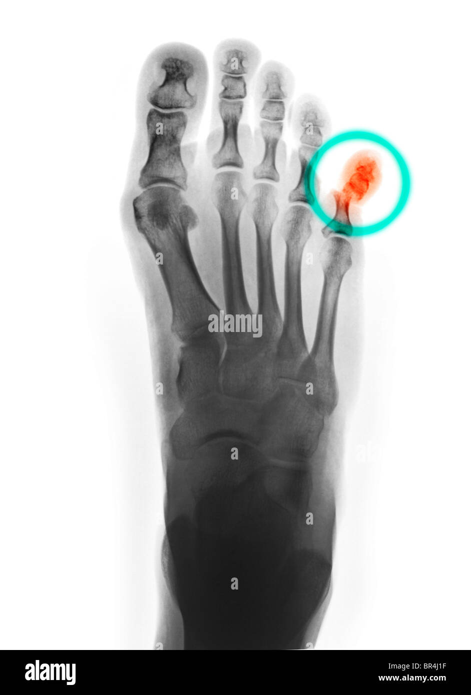 Piedi x-ray di 53 anno vecchia donna che sbatteva il suo piede e si è fratturato la falange prossimale del suo mignolo Foto Stock