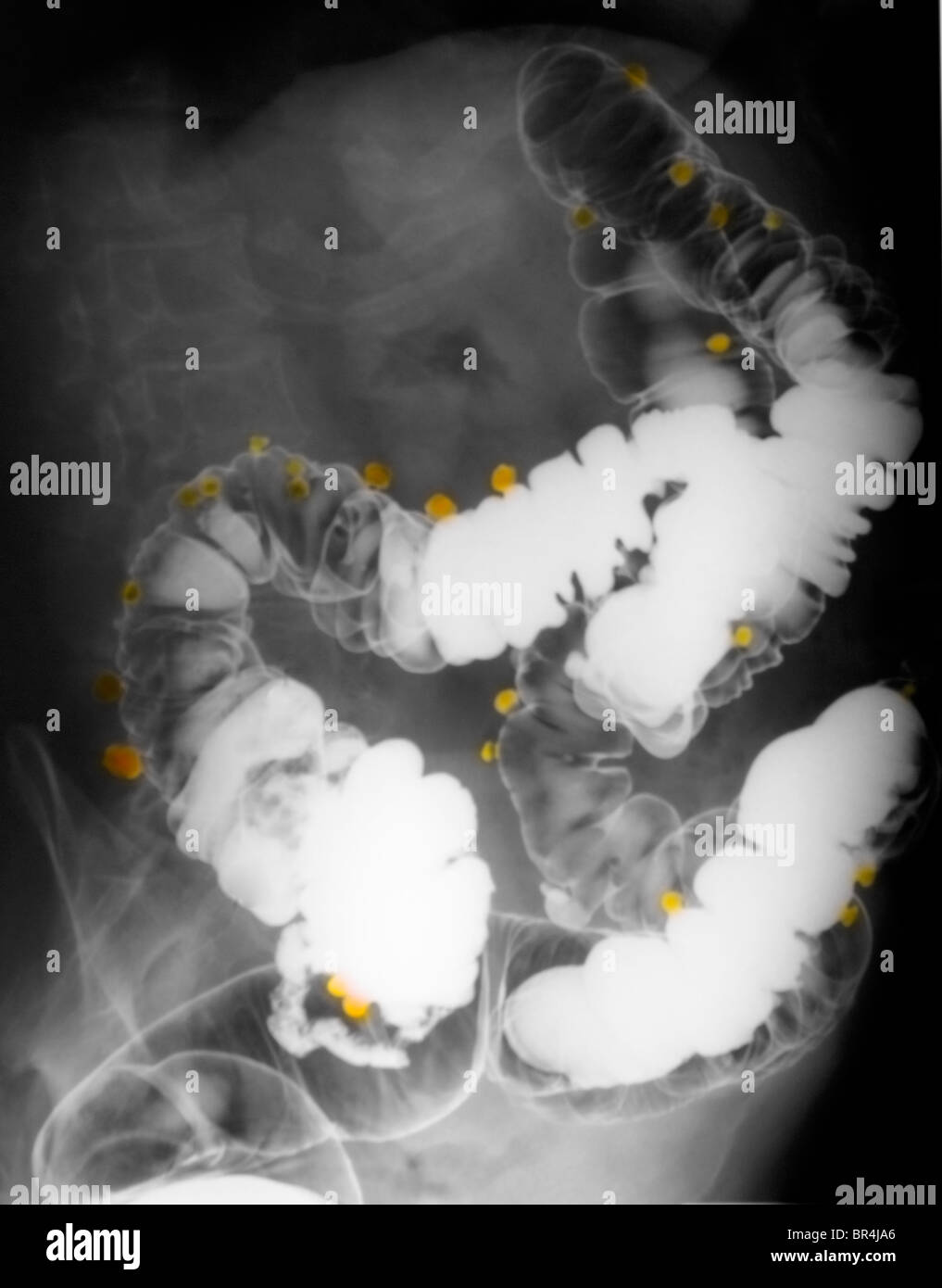 Addome x-ray del bario esame di contrasto che mostra la diverticolosi del colon di un 67 anno vecchia donna Foto Stock