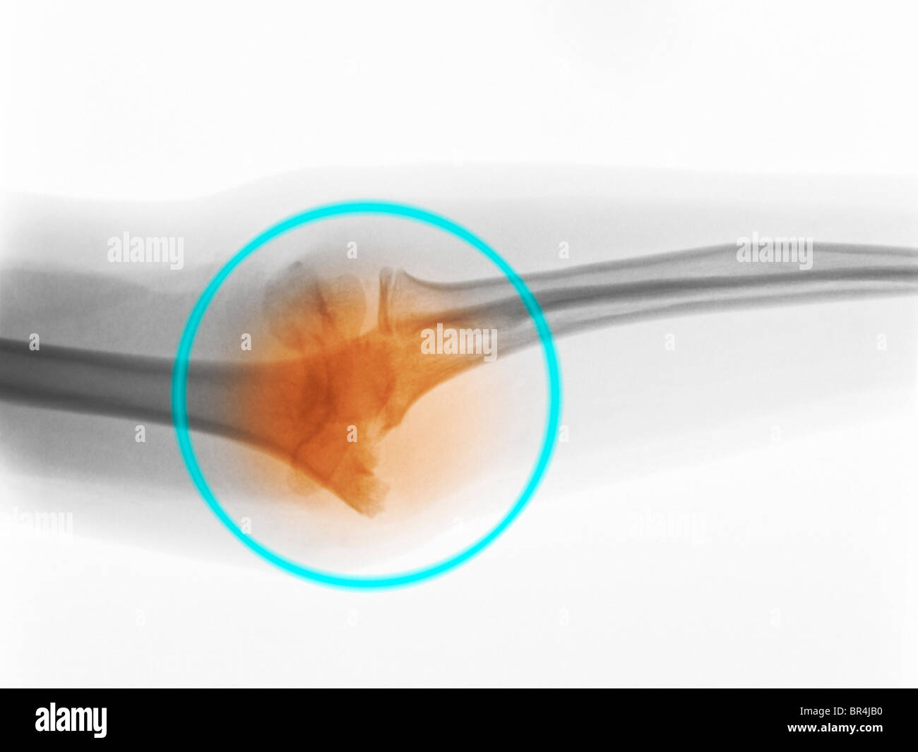 Il gomito di raggi x di un bambino di 8 anni che mostra femmina un male spostato frattura della distale di Omero Foto Stock