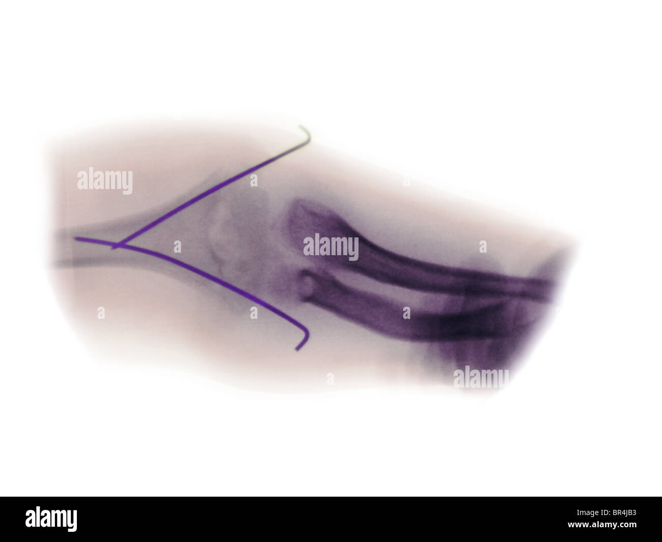 Raggi X che mostra un gomito rottura in una bimba di 8 anni, Foto Stock