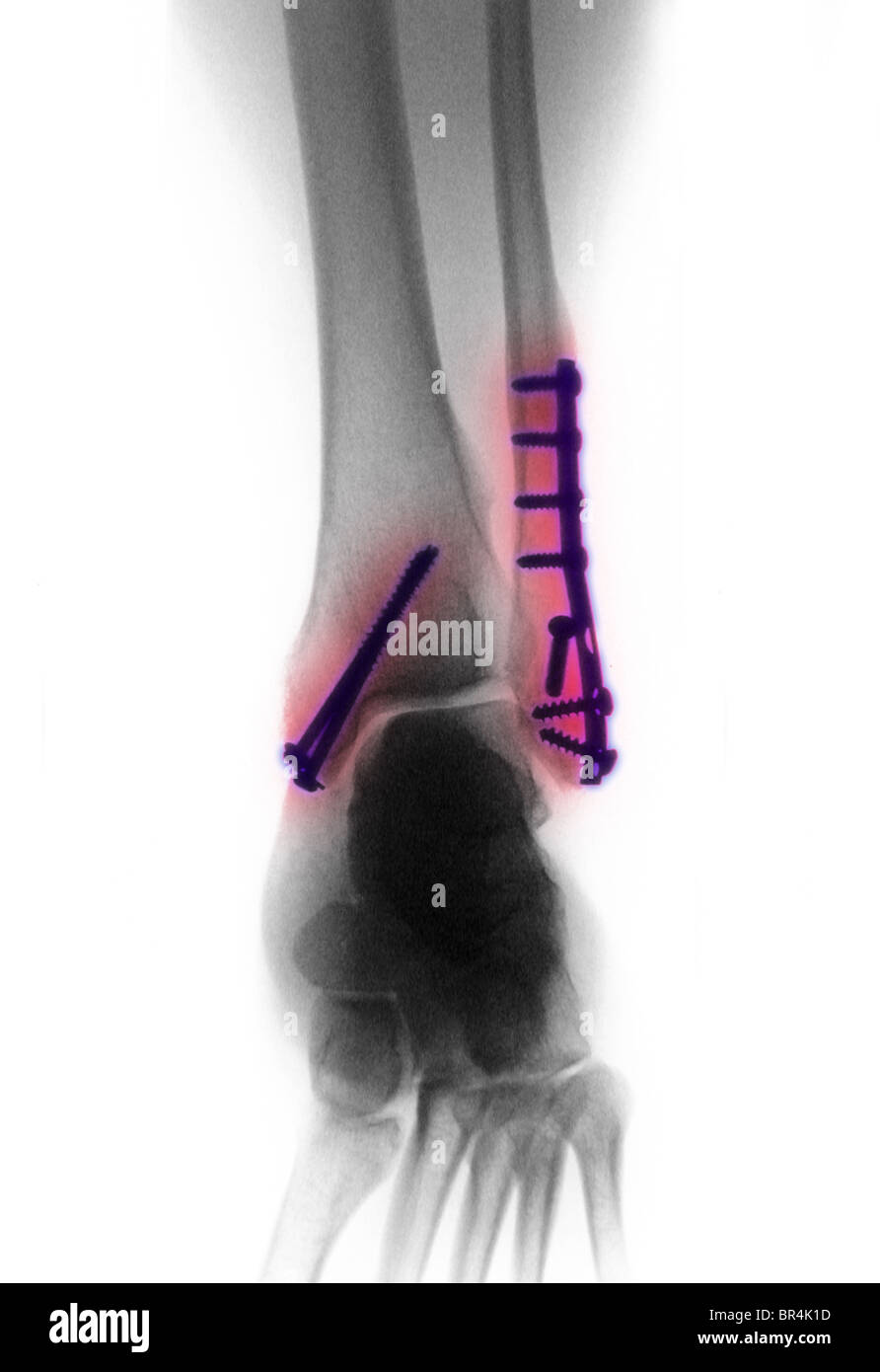 X-ray della caviglia di un 26 anno vecchio che mostra le viti e piastre utilizzate per la riparazione di una frattura e lussazione della caviglia Foto Stock