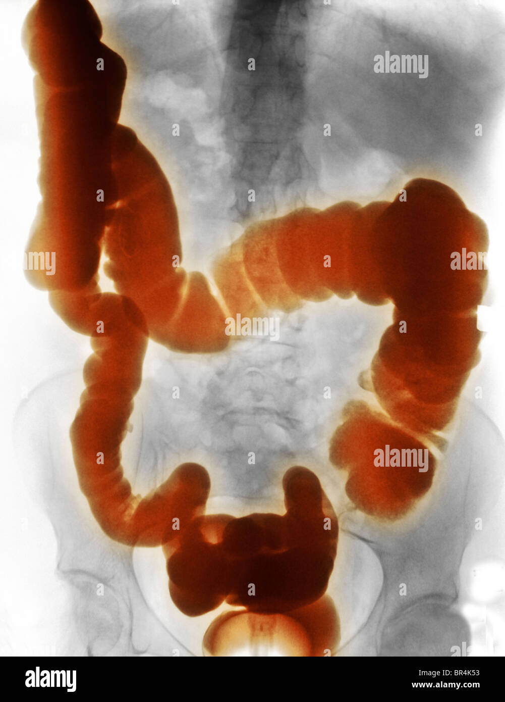 Addome x-ray di 73 anno vecchia donna che aveva un contrasto di bario studio della sua colon Foto Stock