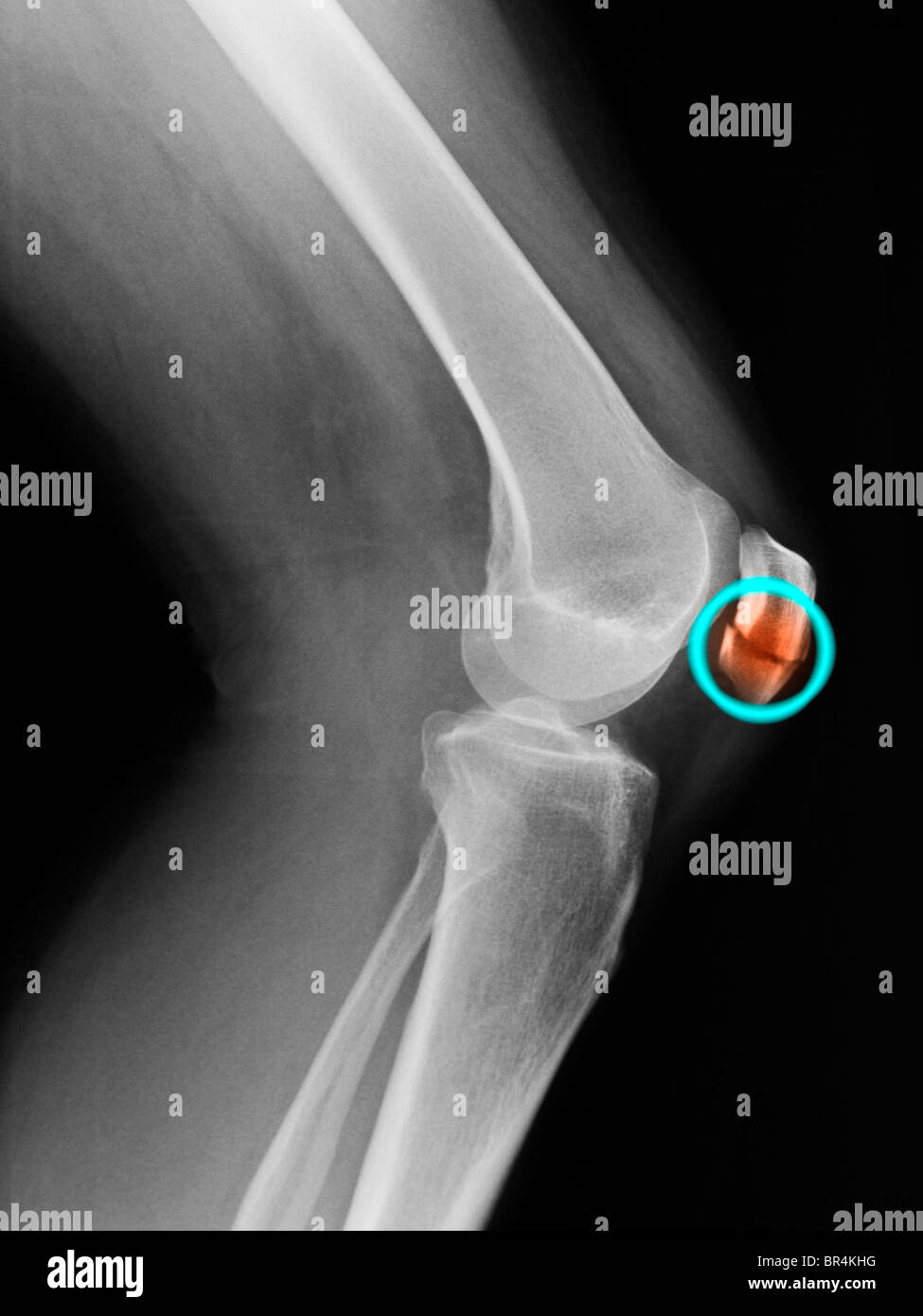 X-ray del ginocchio di 55 anno vecchia donna che mostra una rotula fratturata Foto Stock